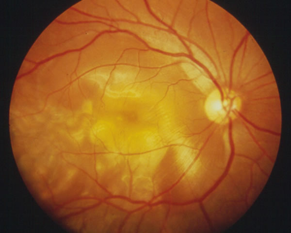 神経梅毒とは何ですか?