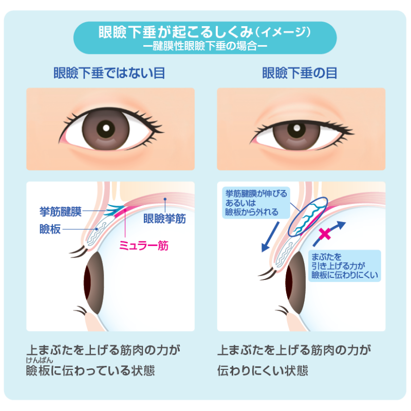 眼瞼下垂が起こるしくみ（イメージ）