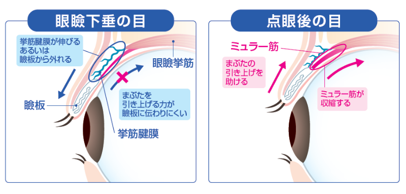 眼瞼下垂の目と点滴後の目のイラスト